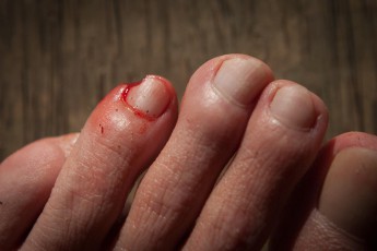 Während eines Erfrischungbads im Fluss, lauert ein Tier eingebuddelt im Grund. Und schnappt zu. Weichschildkröten besitzen scharfe Schnäbel und sind Fleischfresser. Es sieht schlimmer aus als es ist: mit einem Verband kann ich weiterlaufen.